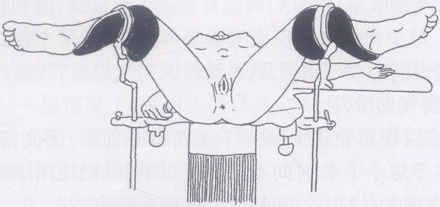 四、陰式手術